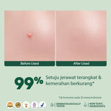 【NEW LAUNCH】NPURE ACNE CLEAR PATCH ISI 18pcs / Patch Jerawat / Acne Skin
