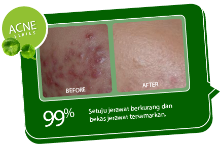 CICA ACNE FACE TONER