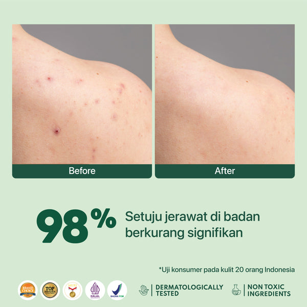 NPURE Bacne Spray Untuk Jerawat Punggung & Badan