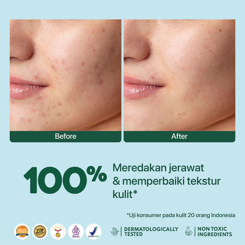 NPURE Anti Acne Biome Serum - Serum Anti Jerawat