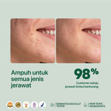 NPURE ACNE SPOT TREATMENT 20GR